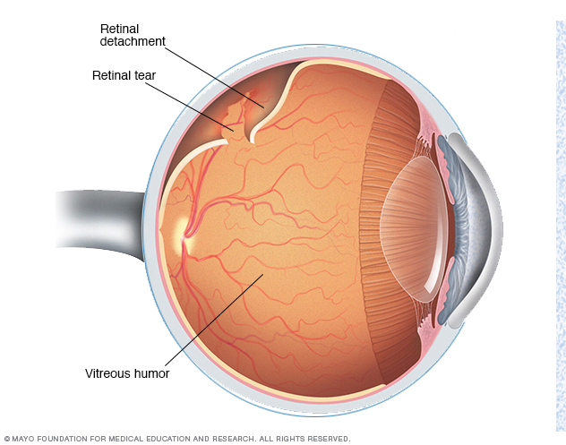 Common Retinal Issues