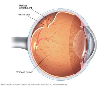 Common Retinal Issues